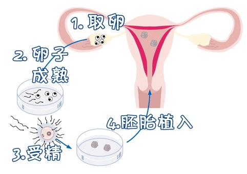 反覆流產